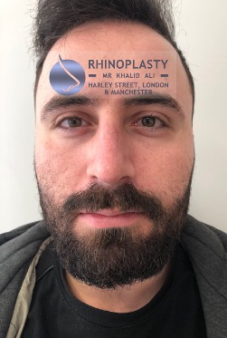 Rhinoplasty Harley Street | Before and After Gallery gallery image 14
