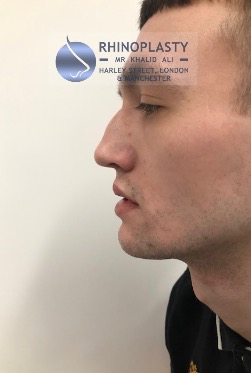 Rhinoplasty Harley Street | Before and After Gallery gallery image 17