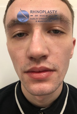 Rhinoplasty Harley Street | Before and After Gallery gallery image 15